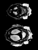 Cranial sutures highlighted in the b0 image