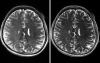 7T MR image with perivascular spaces and its enhance image