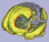 Functional Network 2, corpus callosum, hippocampus, stereo