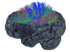 individual with stroke: tractography 