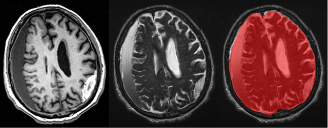 A subject with subdural and subacute epidural hematoma