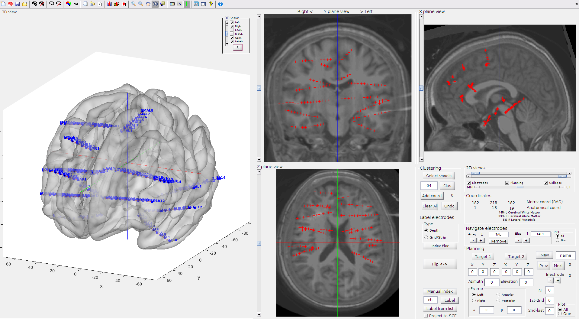 Depth electrodes localization