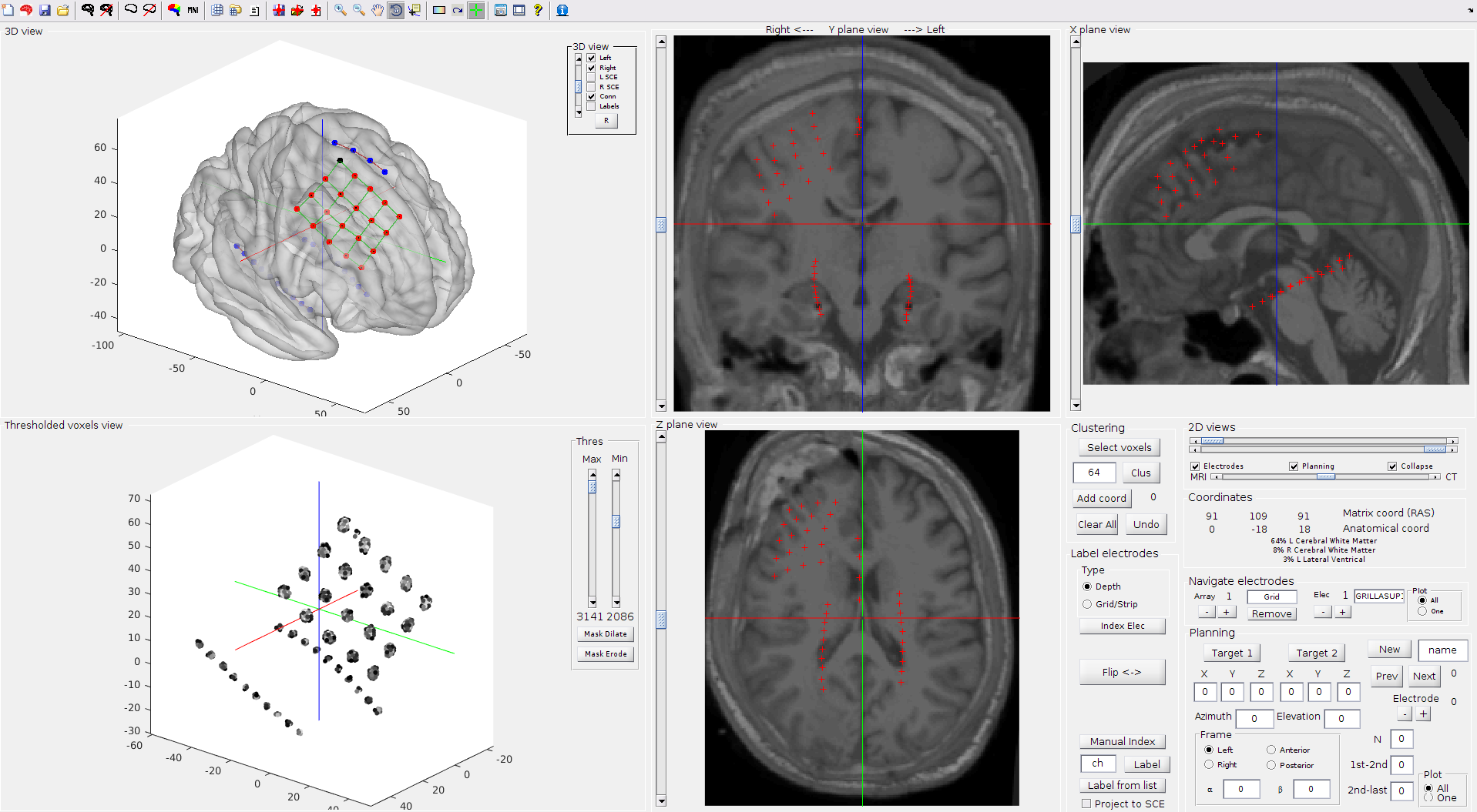 SEEG and ECoG electrode localization