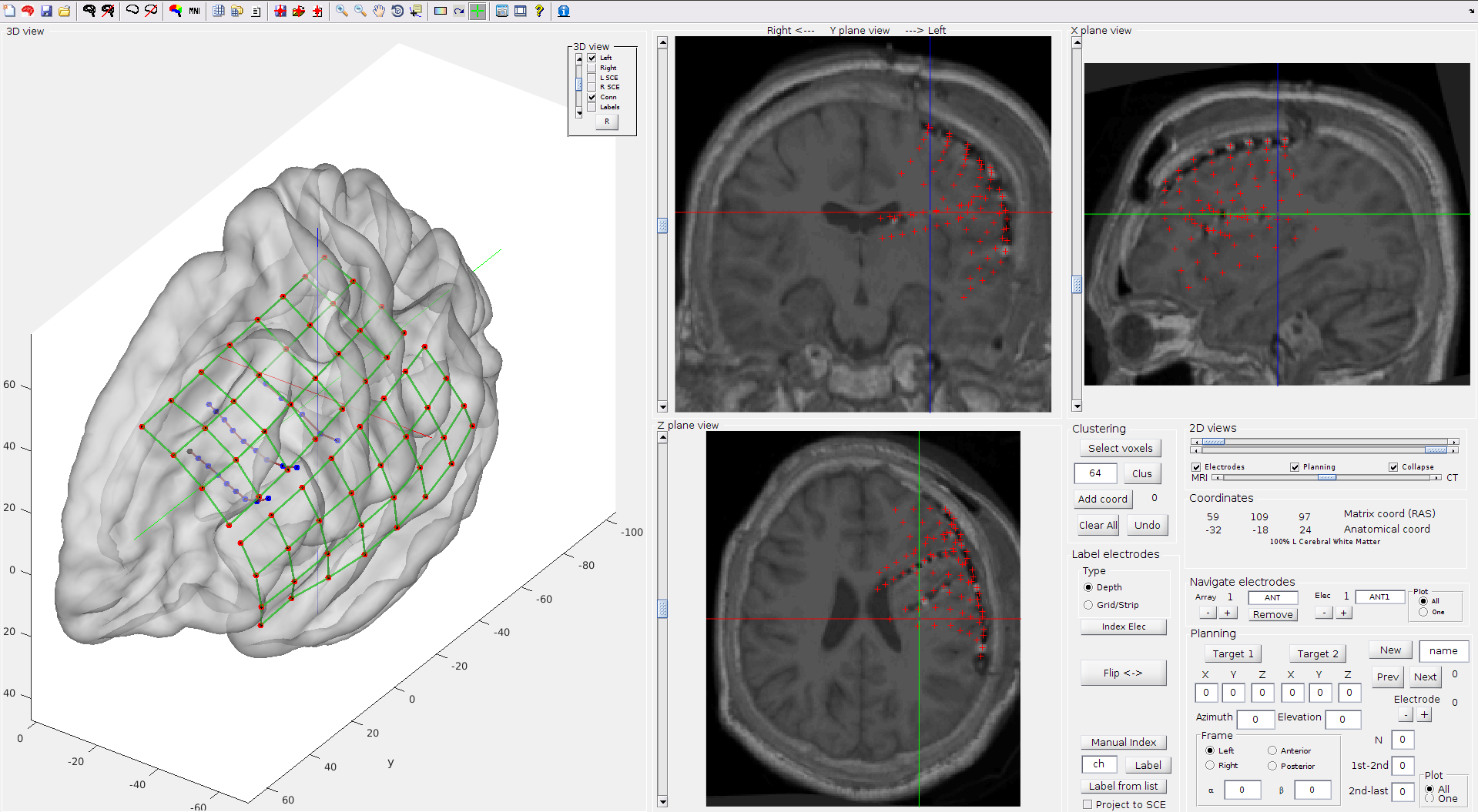 Grid and depth electrodes localization