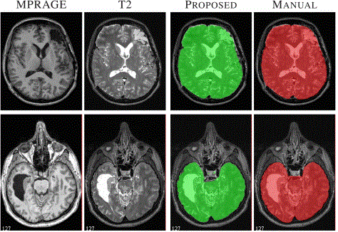 Human MRI with TBI