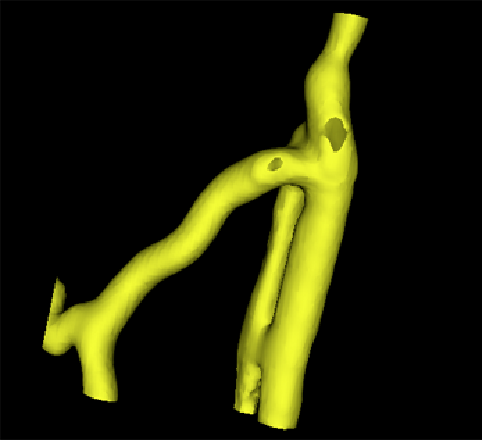 A segmented vascular tree using VMTKEasyLevelSetSegmentation
