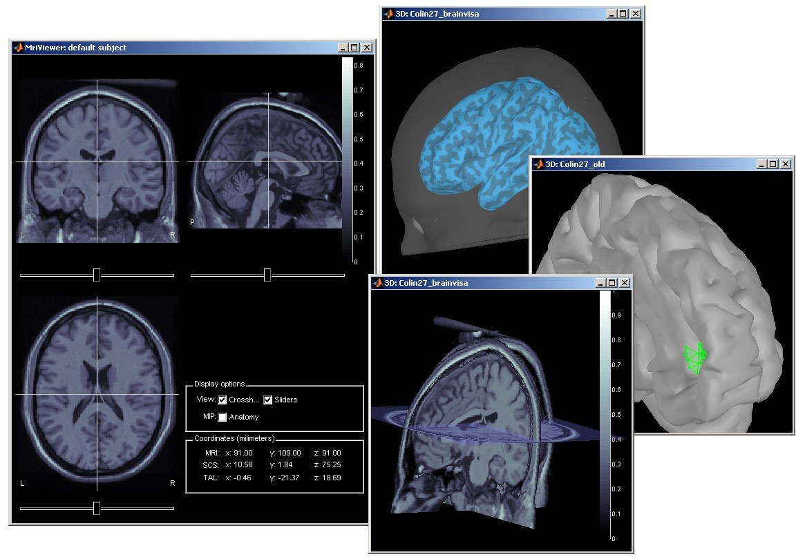 Subject anatomy: MRI and surfaces