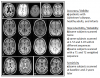 MRI data available in BSTP