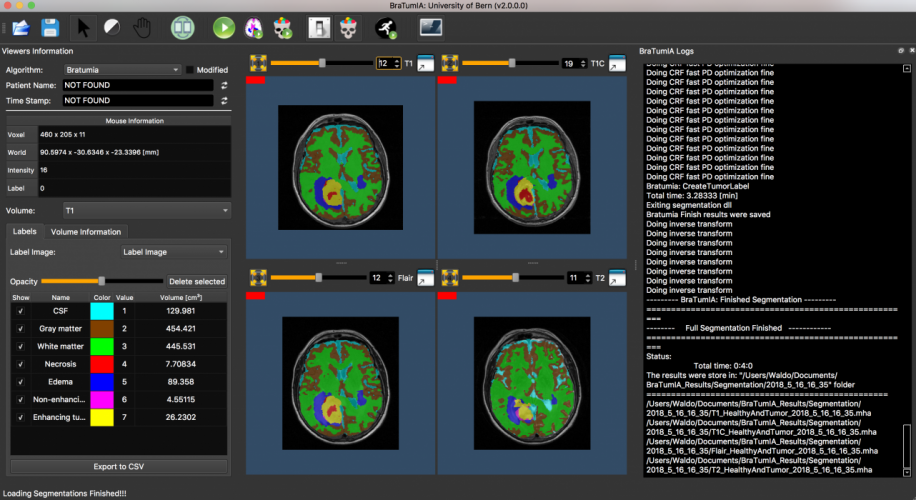 BraTumIA v2.0