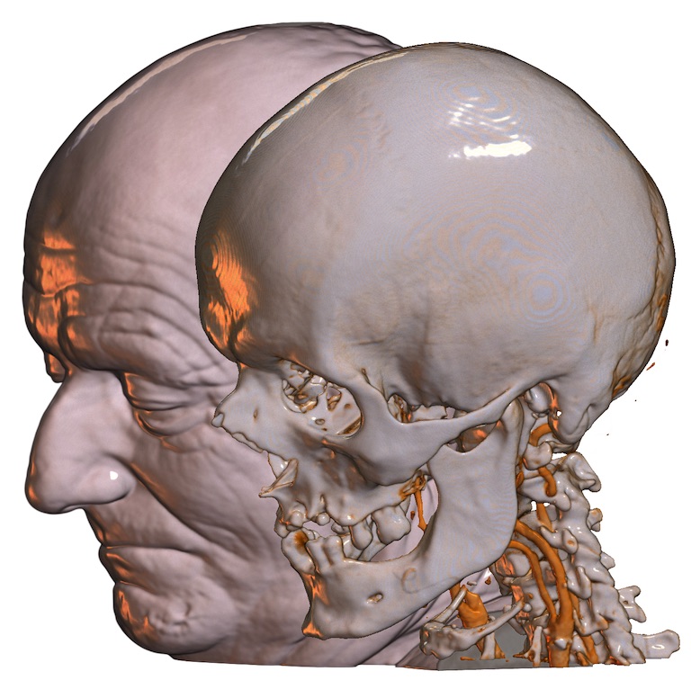Head CT scan