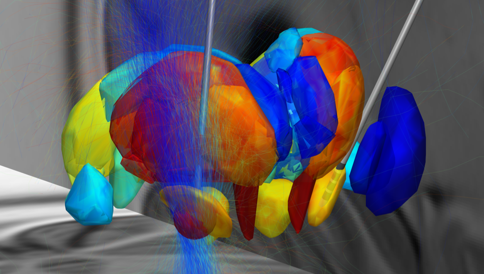 3D-Visualization of DBS electrode placement, modeling of VAT