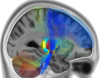 Fiber tracking to regions of the brain connected to the VAT